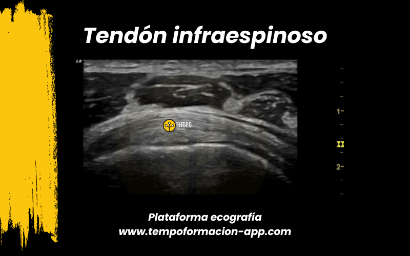 2. Ecografia tempo formacion manguito rotador tendon supraespinoso infraespinoso redondo menor subescapular.png